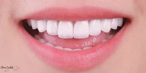 کامپوزیت دندان خرگوشی چیست + مزایا و معایب + هزینه