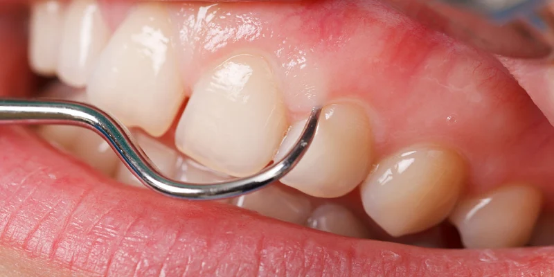علل حساسیت دندان پس از جرم‌گیری