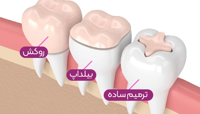 بازسازی دندان