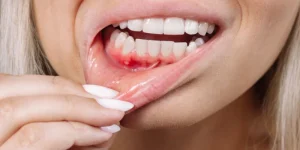 درمان عفونت لثه فوری | برای عفونت لثه چی بخوریم؟